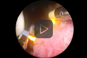 Bipolar TURBT with VIO 3