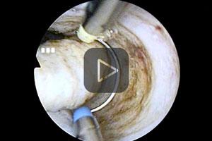 Bipolar TURP with VIO-3