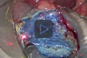 TEM-ESD with VIO 3 using preciseSECT mode