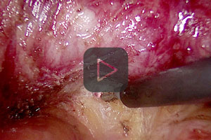 TME with VIO 3 using preciseSECT mode