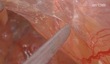 Extended PLND for high risk prostate cancer using VIO 3 preciseSECT